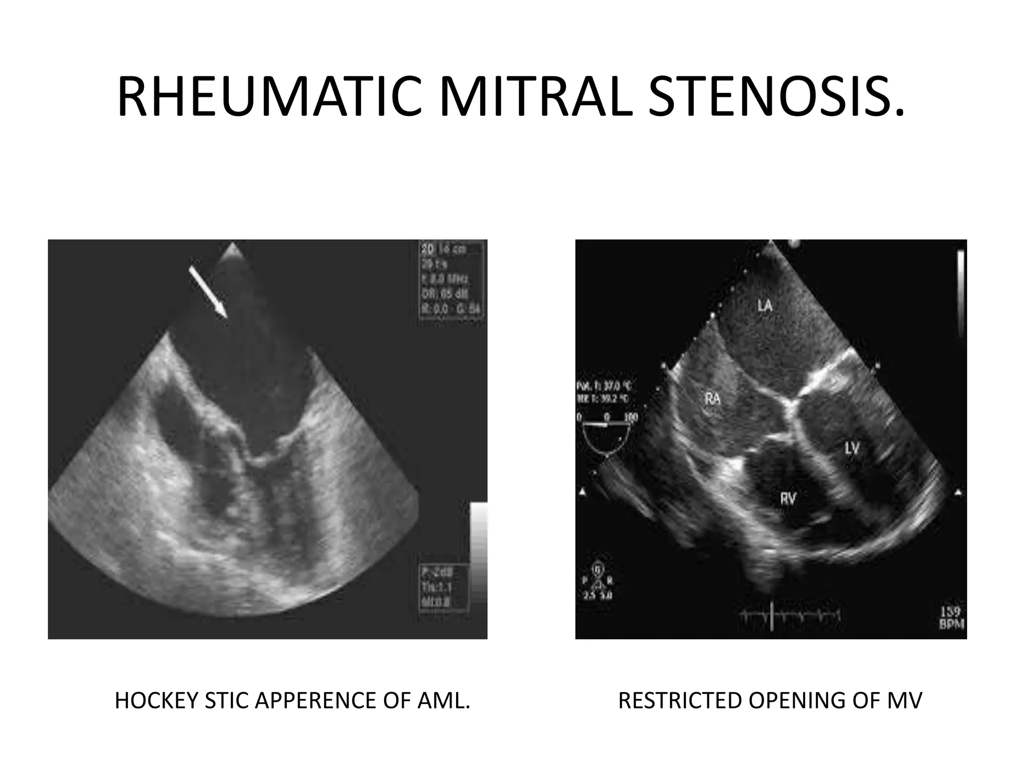 assessment-of-mitral-valve-by-tee-pptx