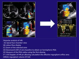MITRAL REGURGITATION IN ECHOCARDIOGRAPHY | PPSX