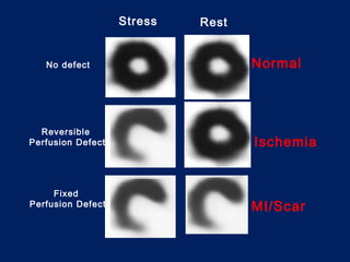 Assessment of myocardial viability | PPT