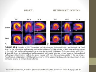 Assessment of Myocardial Viability Using Nuclear Medicine Imaging in  Dextrocardia