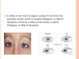  A reflex in the mid-iris region is about 4 mm from the
pupillary center, which is roughly 30degree, or 60Δ of
deviation; similarly, a reflex at the limbus is about
45degree, or 90Δ of deviation
 