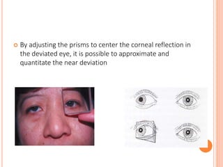  By adjusting the prisms to center the corneal reflection in
the deviated eye, it is possible to approximate and
quantitate the near deviation
 