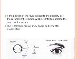  If the position of the fovea is nasal to the pupillary axis,
the corneal light reflection will be slightly temporal to the
center of the cornea
 This is termed negative angle kappa and simulates
esodeviation
 