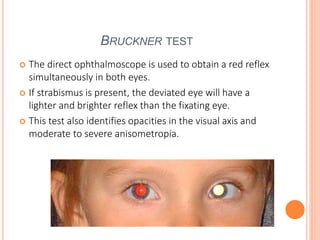 BRUCKNER TEST
 The direct ophthalmoscope is used to obtain a red reflex
simultaneously in both eyes.
 If strabismus is present, the deviated eye will have a
lighter and brighter reflex than the fixating eye.
 This test also identifies opacities in the visual axis and
moderate to severe anisometropia.
 