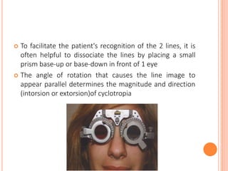  To facilitate the patient's recognition of the 2 lines, it is
often helpful to dissociate the lines by placing a small
prism base-up or base-down in front of 1 eye
 The angle of rotation that causes the line image to
appear parallel determines the magnitude and direction
(intorsion or extorsion)of cyclotropia
 