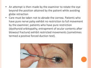 • An attempt is then made by the examiner to rotate the eye
beyond the position attained by the patient while avoiding
globe retraction
• Care must be taken not to abrade the cornea. Patients who
have pure nerve palsy exhibit no restriction to full movement
by the examiner; patients who have pure restriction
(dysthyroid orbitopathy, entrapment of ocular contents after
blowout fracture) exhibit restricted movements (sometimes
termed a positive forced duction test).
 