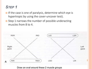 STEP 1
 If the case is one of paralysis, determine which eye is
hypertropic by using the cover-uncover test).
 Step 1 narrows the number of possible underacting
muscles from 8 to 4.
Draw an oval around these 2 muscle groups
 