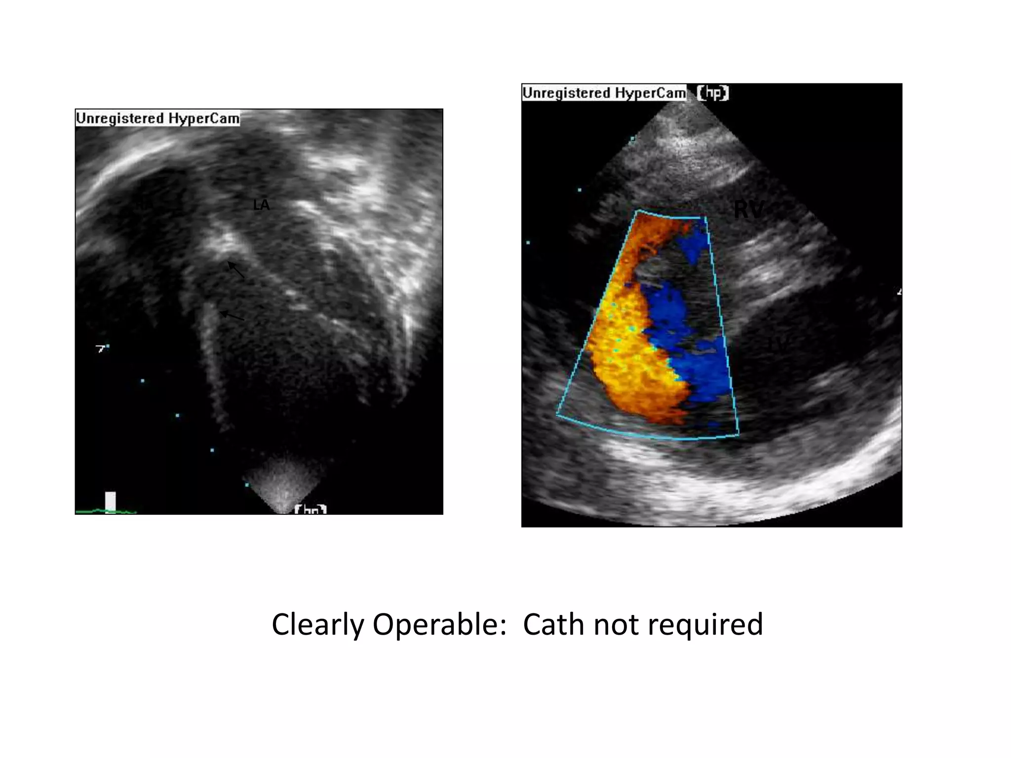 LV
RVLA
LV
RA
RV
Clearly Operable: Cath not required
 