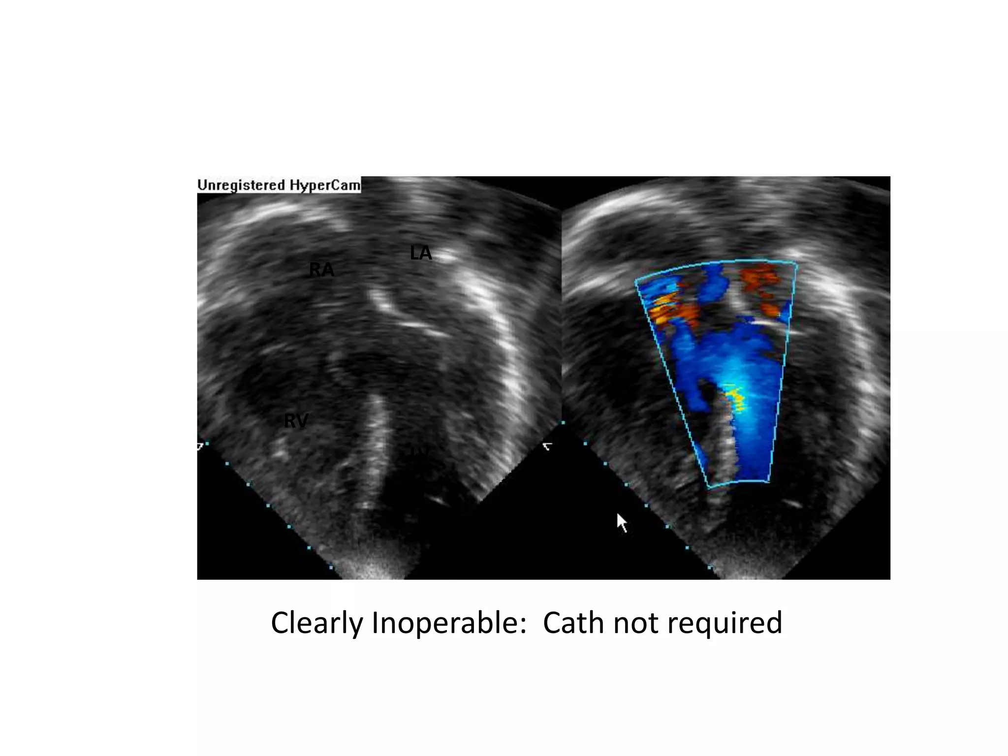 Clearly Inoperable: Cath not required
RV
LV
RA
LA
 