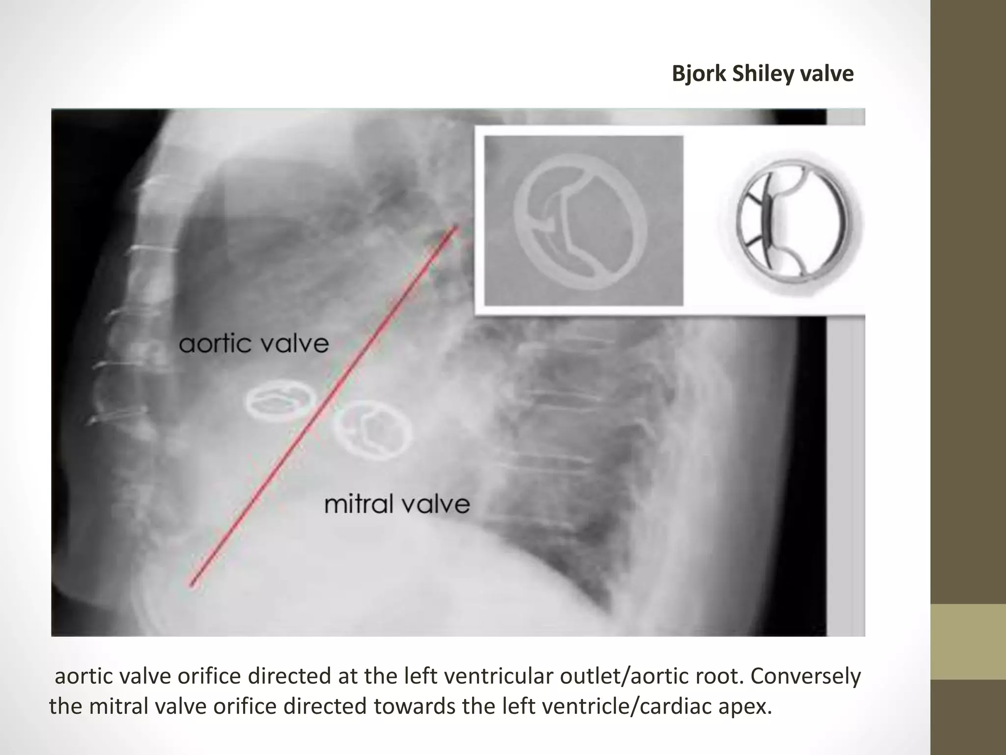aortic valve orifice directed at the left ventricular outlet/aortic root. Conversely
the mitral valve orifice directed towards the left ventricle/cardiac apex.
Bjork Shiley valve
 