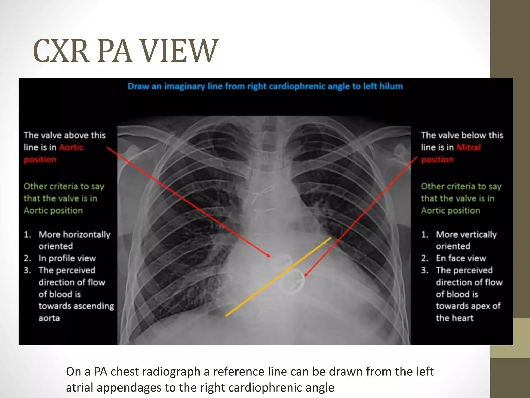 CXR PA VIEW
On a PA chest radiograph a reference line can be drawn from the left
atrial appendages to the right cardiophrenic angle
 