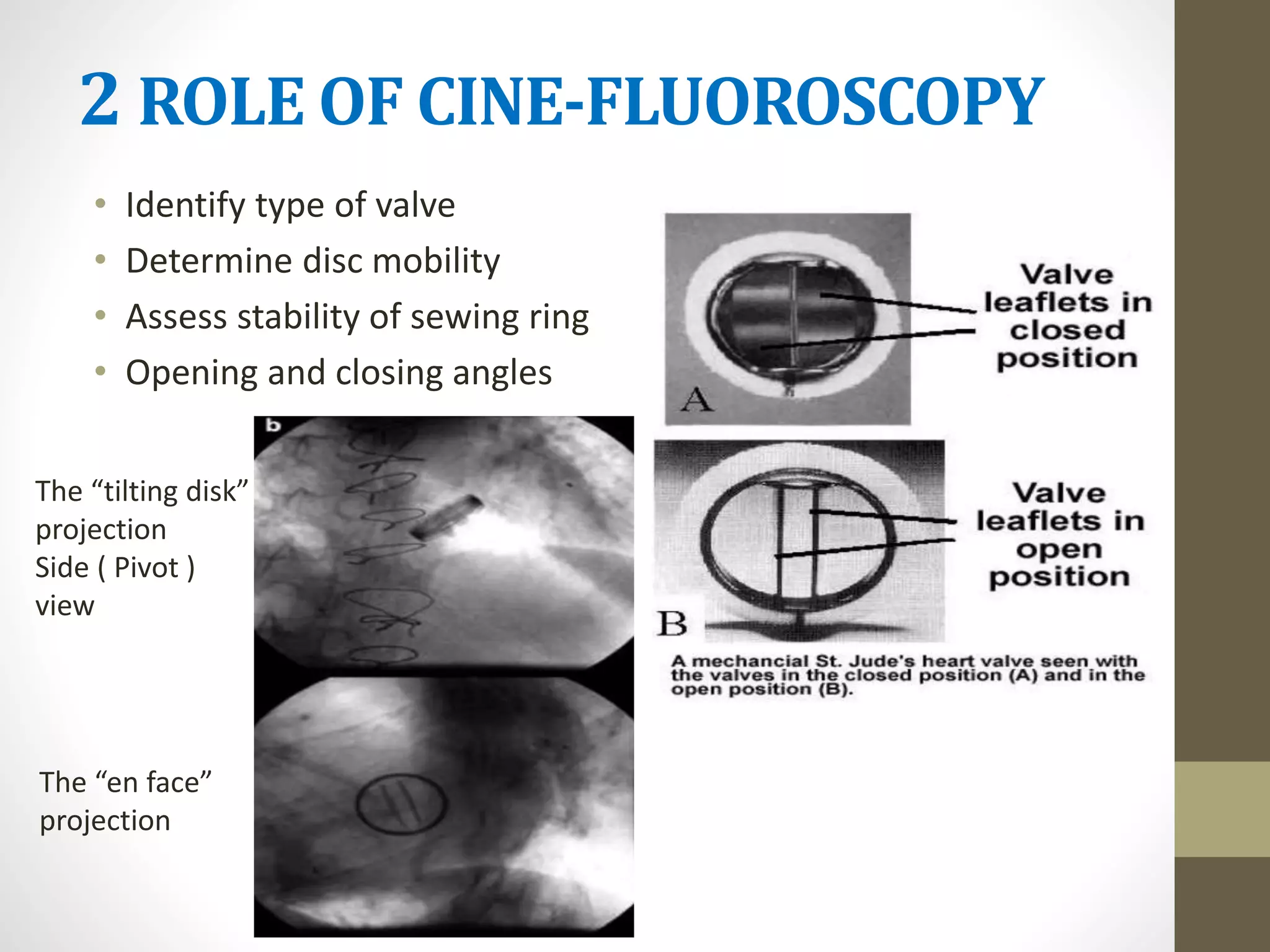 2 ROLE OF CINE-FLUOROSCOPY
• Identify type of valve
• Determine disc mobility
• Assess stability of sewing ring
• Opening and closing angles
The “en face”
projection
The “tilting disk”
projection
Side ( Pivot )
view
 