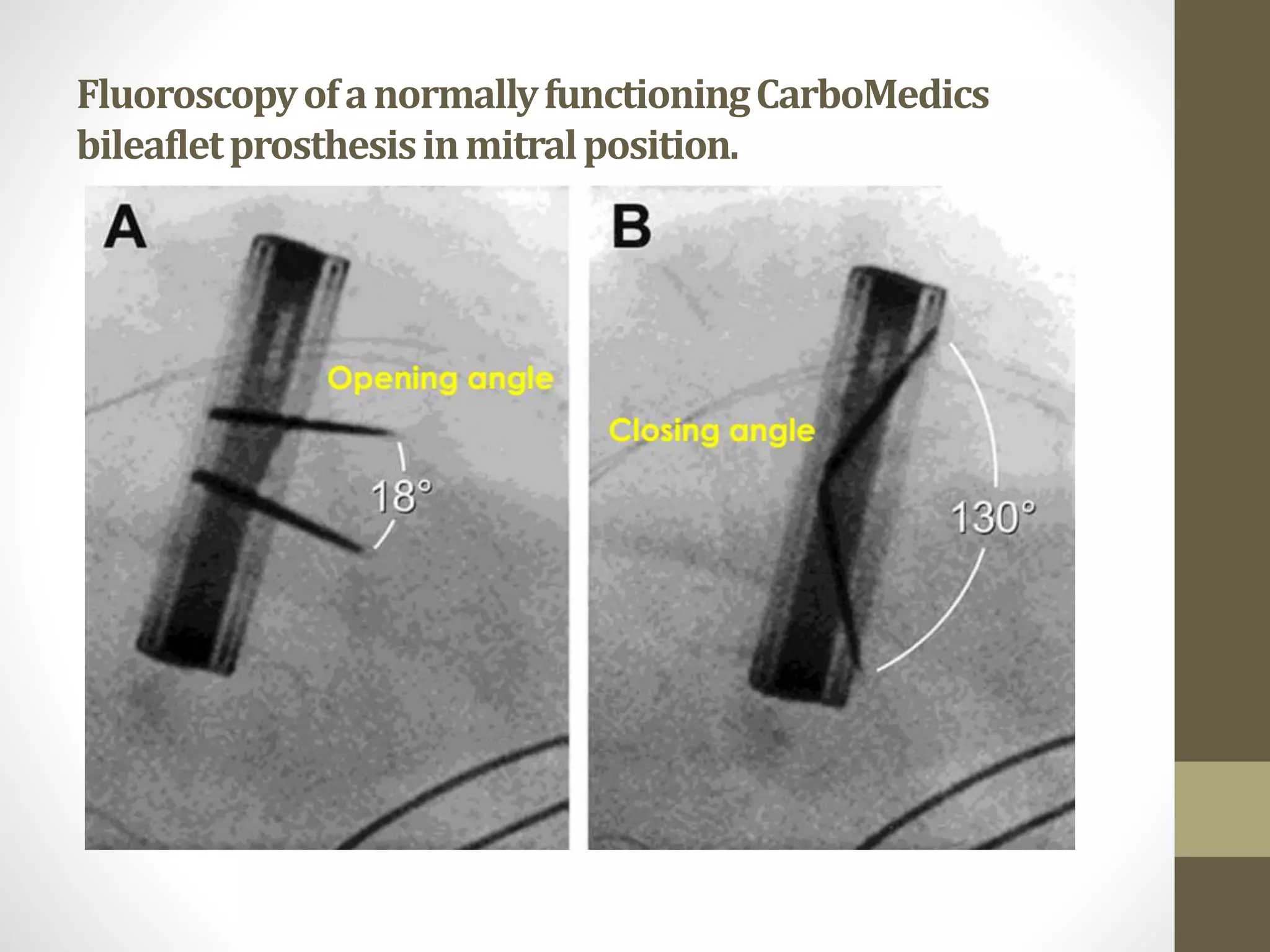 FluoroscopyofanormallyfunctioningCarboMedics
bileafletprosthesisinmitralposition.
•
 