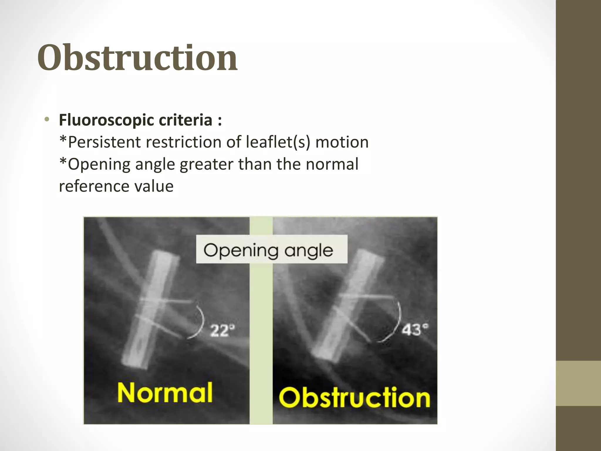 Obstruction
• Fluoroscopic criteria :
*Persistent restriction of leaflet(s) motion
*Opening angle greater than the normal
reference value
 