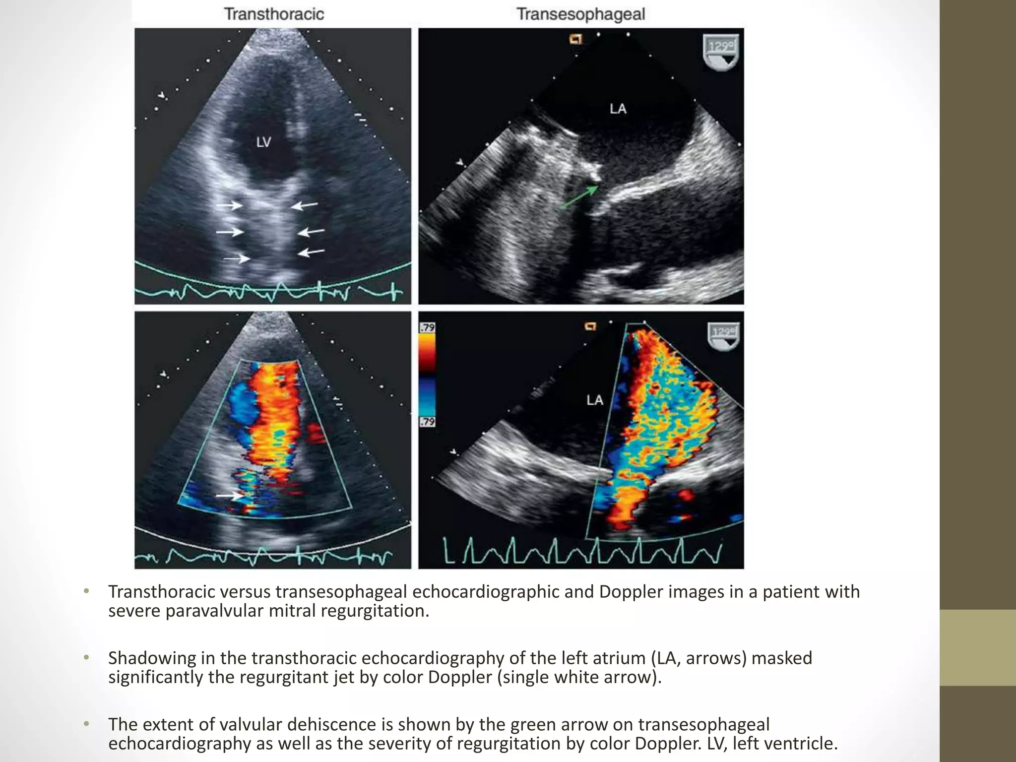 • Transthoracic versus transesophageal echocardiographic and Doppler images in a patient with
severe paravalvular mitral regurgitation.
• Shadowing in the transthoracic echocardiography of the left atrium (LA, arrows) masked
significantly the regurgitant jet by color Doppler (single white arrow).
• The extent of valvular dehiscence is shown by the green arrow on transesophageal
echocardiography as well as the severity of regurgitation by color Doppler. LV, left ventricle.
 