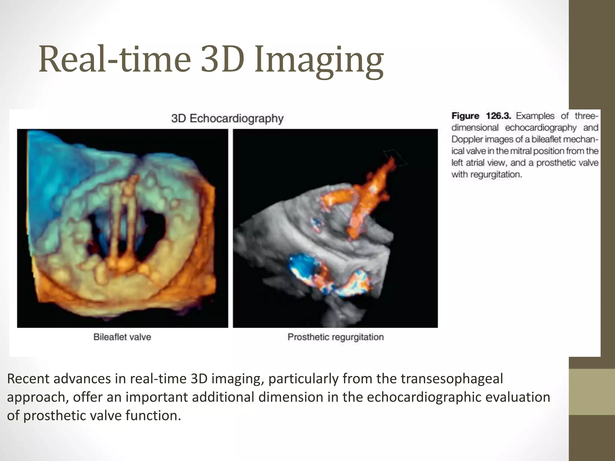 Real-time 3D Imaging
Recent advances in real-time 3D imaging, particularly from the transesophageal
approach, offer an important additional dimension in the echocardiographic evaluation
of prosthetic valve function.
 