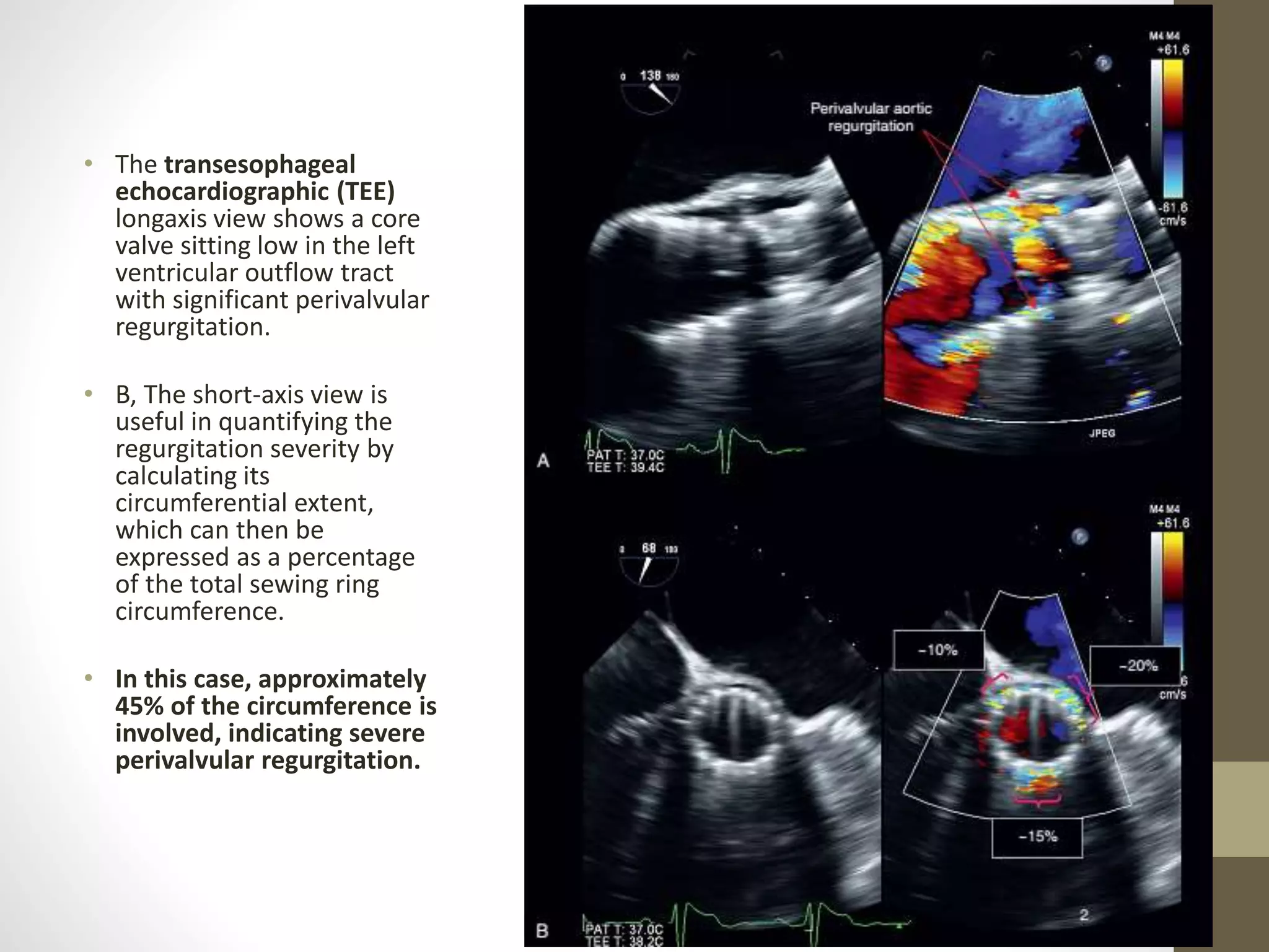 • The transesophageal
echocardiographic (TEE)
longaxis view shows a core
valve sitting low in the left
ventricular outflow tract
with significant perivalvular
regurgitation.
• B, The short-axis view is
useful in quantifying the
regurgitation severity by
calculating its
circumferential extent,
which can then be
expressed as a percentage
of the total sewing ring
circumference.
• In this case, approximately
45% of the circumference is
involved, indicating severe
perivalvular regurgitation.
 