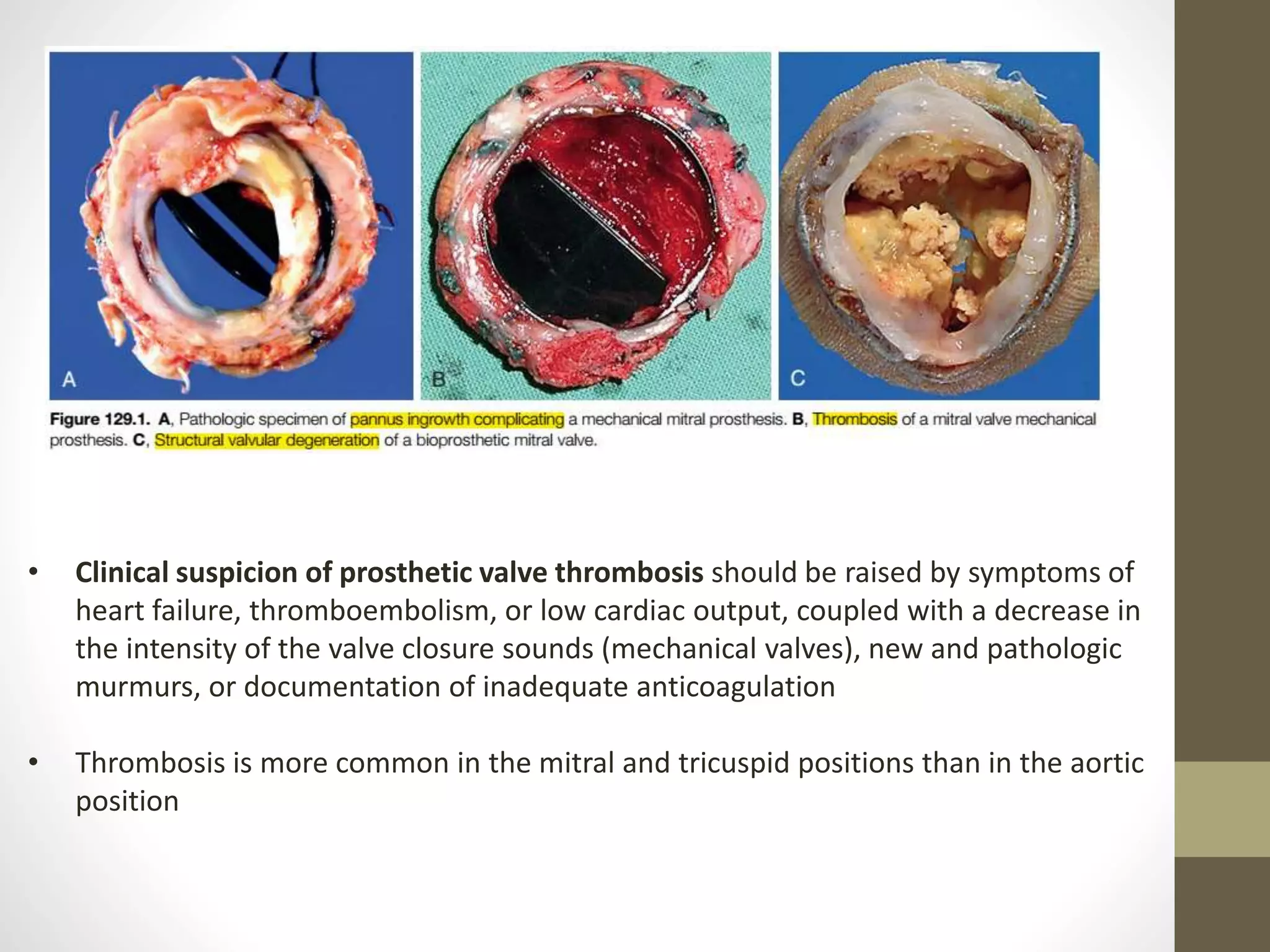 • Clinical suspicion of prosthetic valve thrombosis should be raised by symptoms of
heart failure, thromboembolism, or low cardiac output, coupled with a decrease in
the intensity of the valve closure sounds (mechanical valves), new and pathologic
murmurs, or documentation of inadequate anticoagulation
• Thrombosis is more common in the mitral and tricuspid positions than in the aortic
position
 
