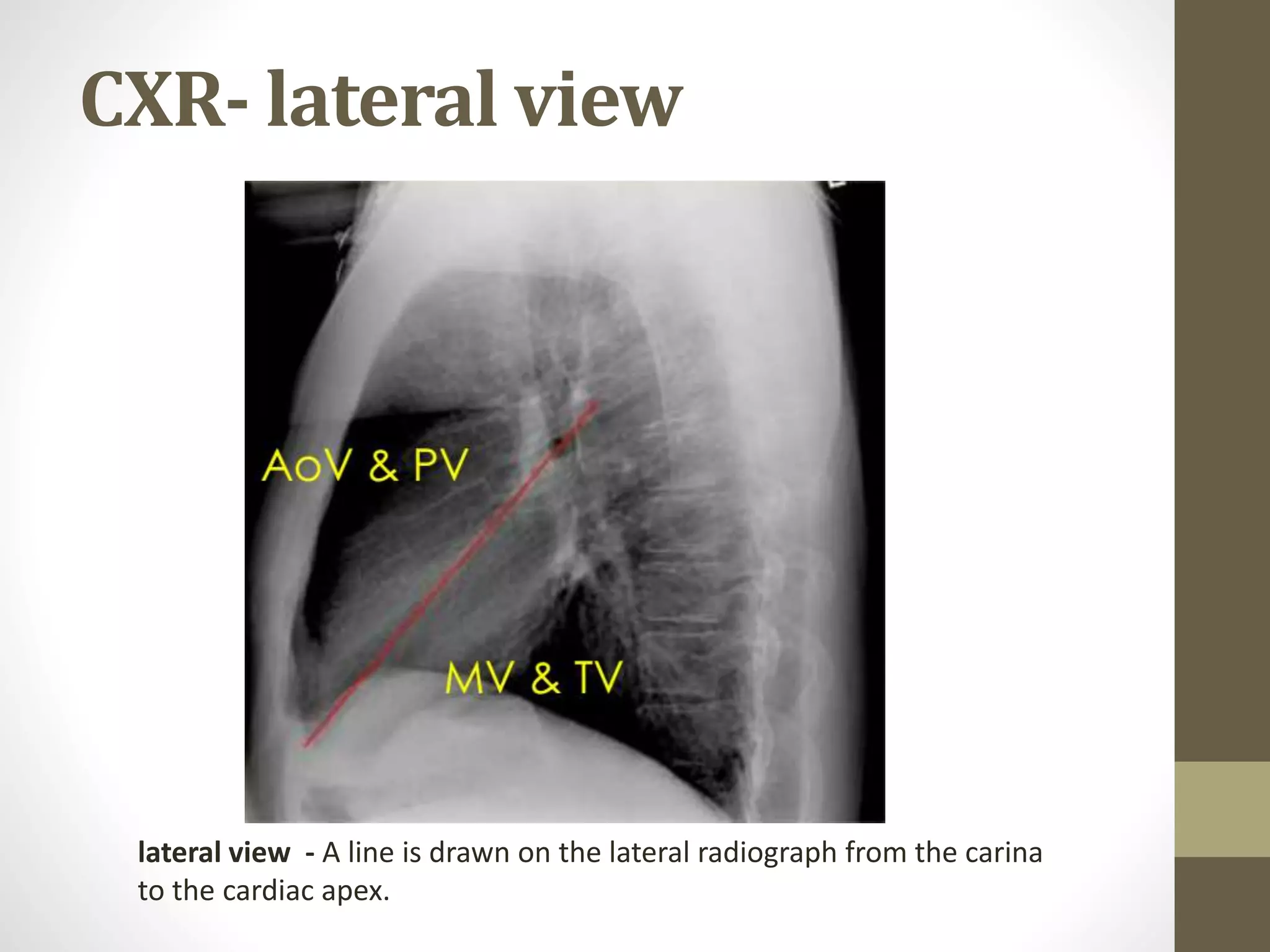 CXR- lateral view
lateral view - A line is drawn on the lateral radiograph from the carina
to the cardiac apex.
 