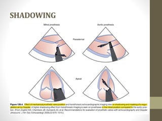 Assessment of prosthetic valve function | PPTX