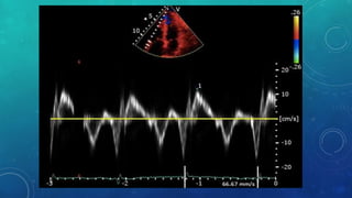 Assessment of rv function | PPTX