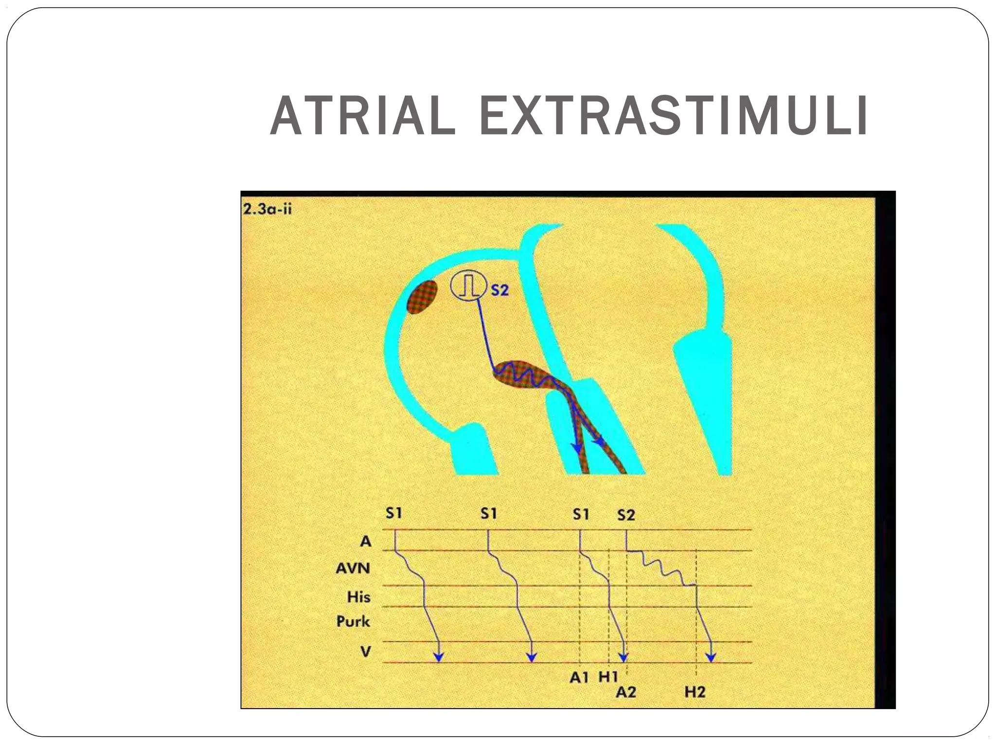 ATRIAL EXTRASTIMULI
 