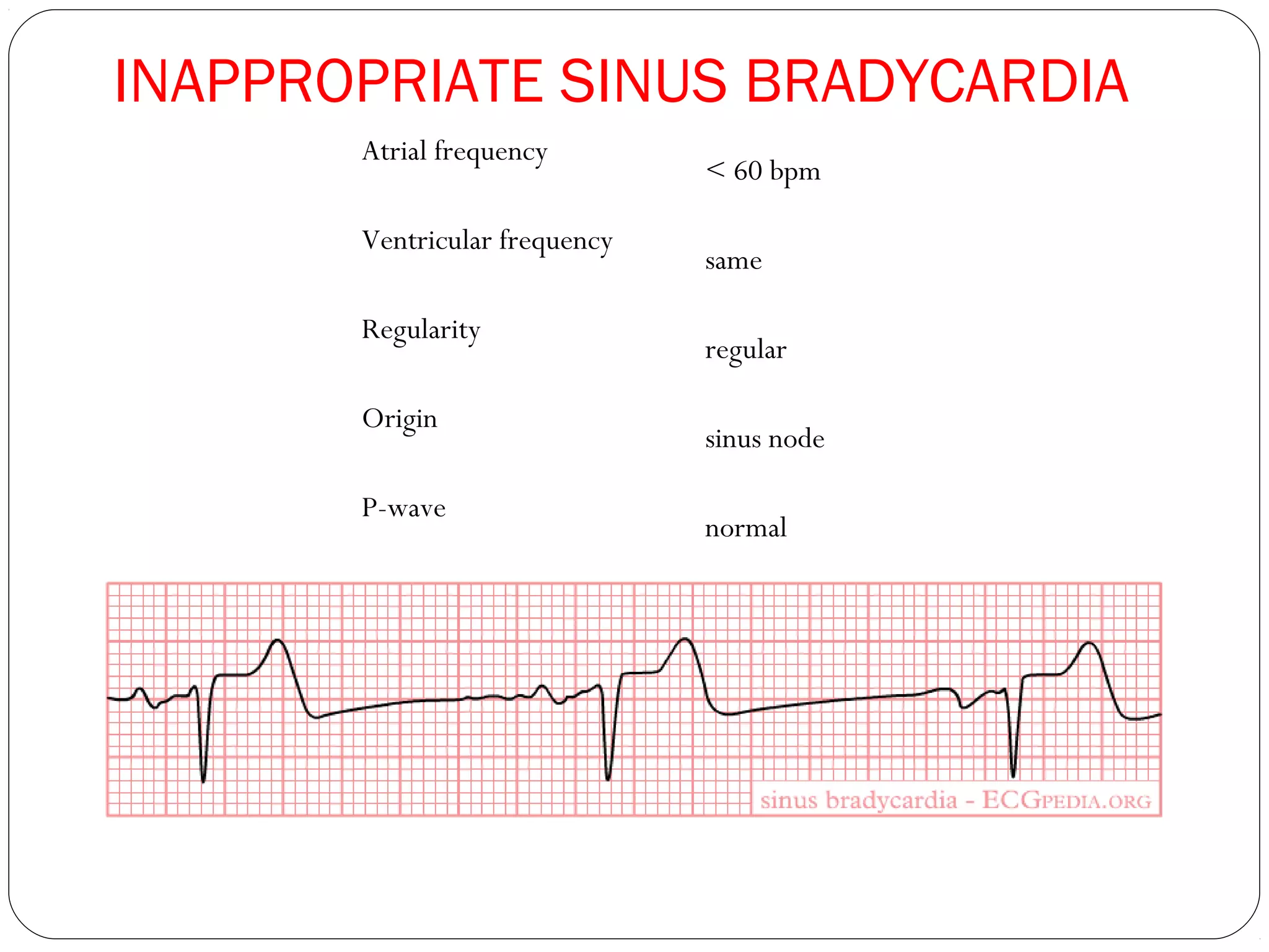 Atrial frequency
< 60 bpm
Ventricular frequency
same
Regularity
regular
Origin
sinus node
P-wave
normal
INAPPROPRIATE SINUS BRADYCARDIA
 