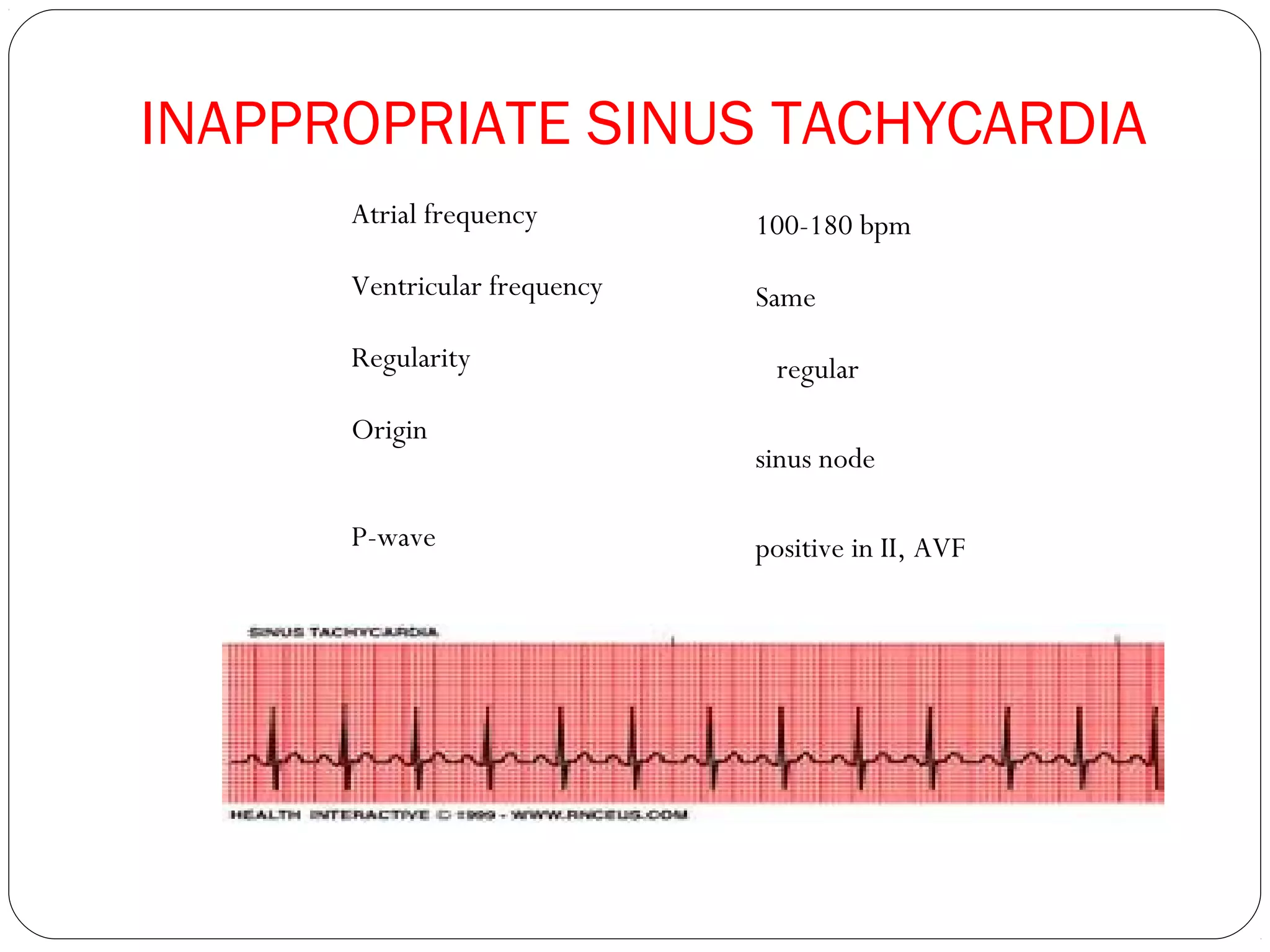 INAPPROPRIATE SINUS TACHYCARDIA
Atrial frequency 100-180 bpm
Ventricular frequency Same
Regularity regular
Origin
sinus node
P-wave positive in II, AVF
 