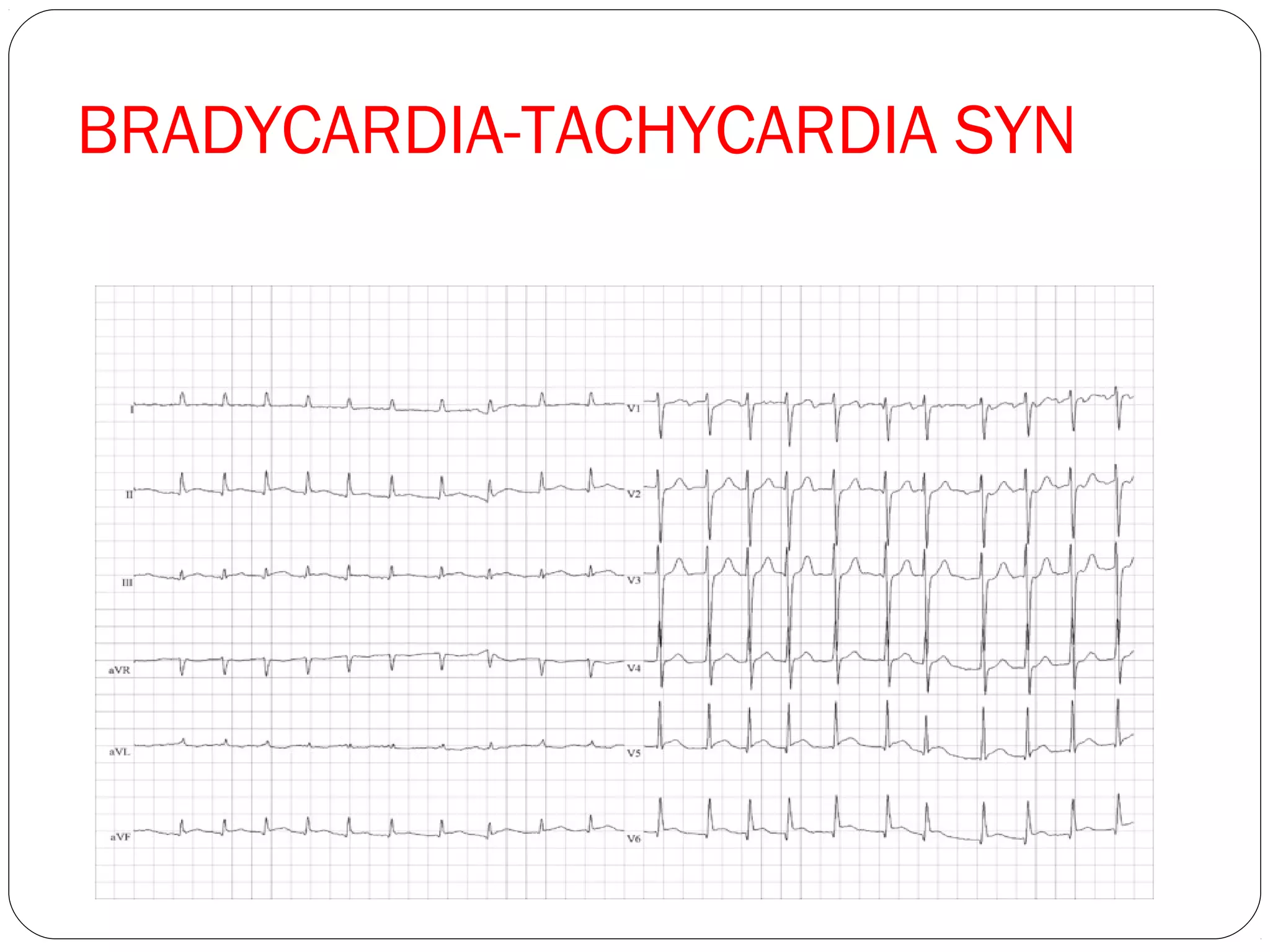 BRADYCARDIA-TACHYCARDIA SYN
 
