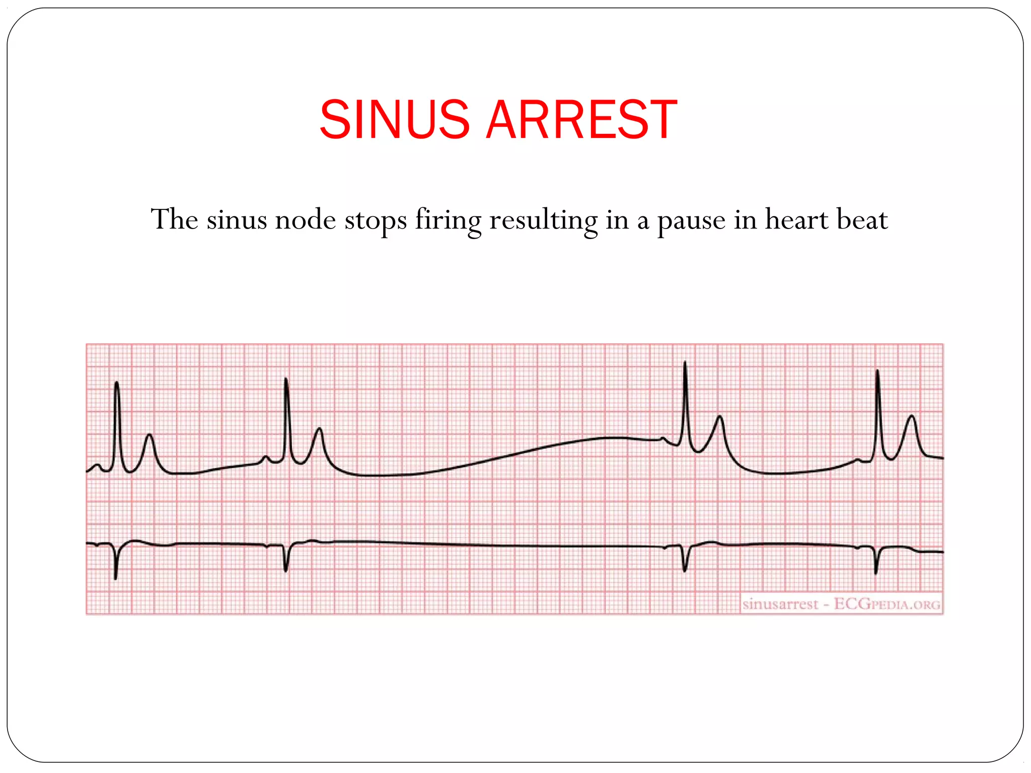 SINUS ARREST
The sinus node stops firing resulting in a pause in heart beat
 