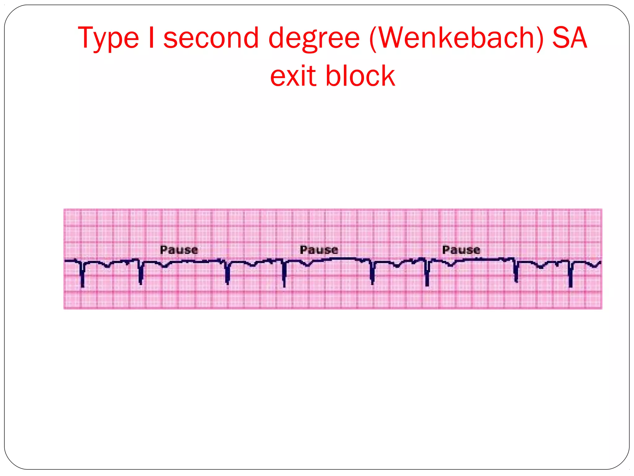 Type I second degree (Wenkebach) SA
exit block
 