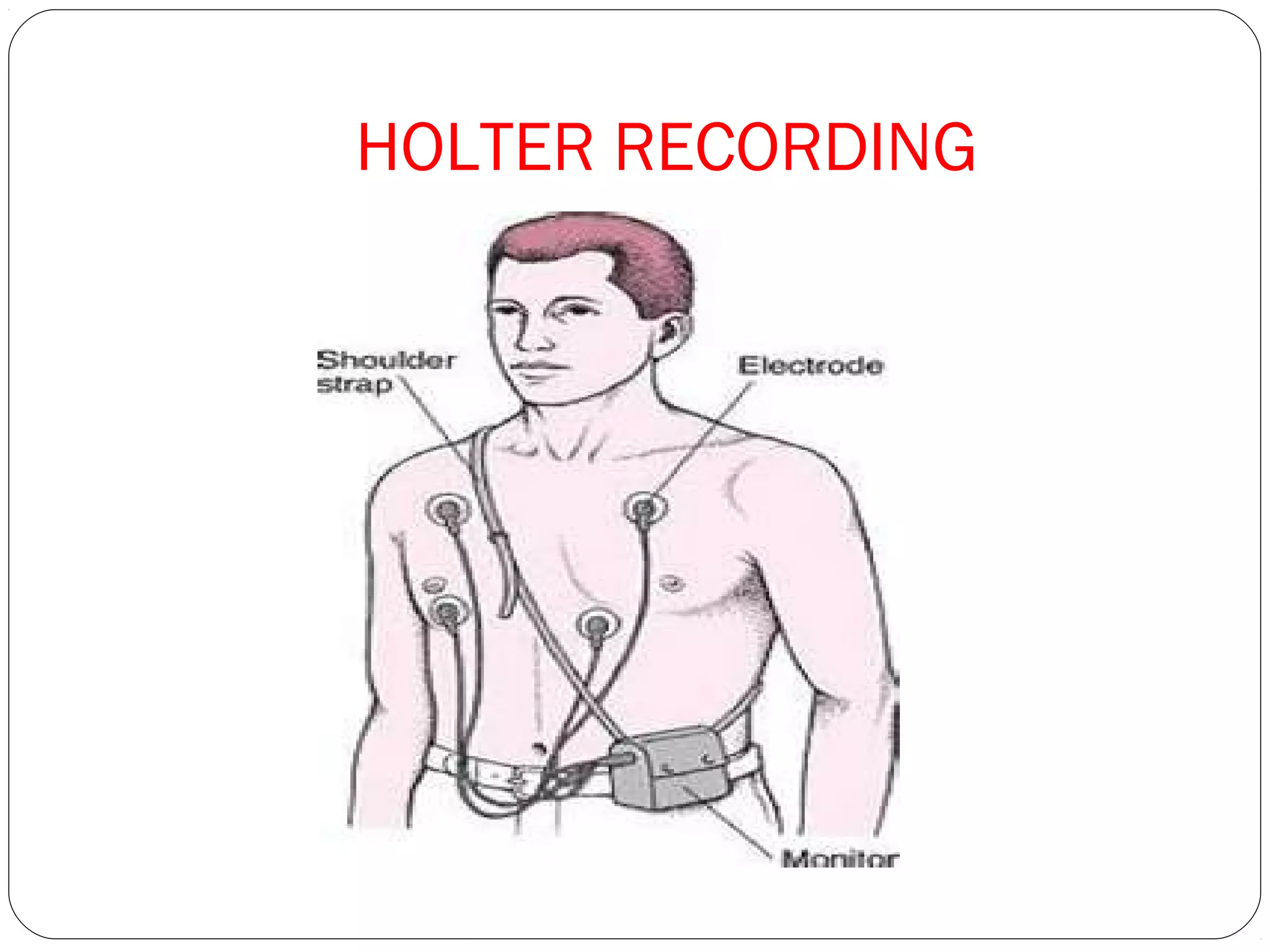 HOLTER RECORDING
 