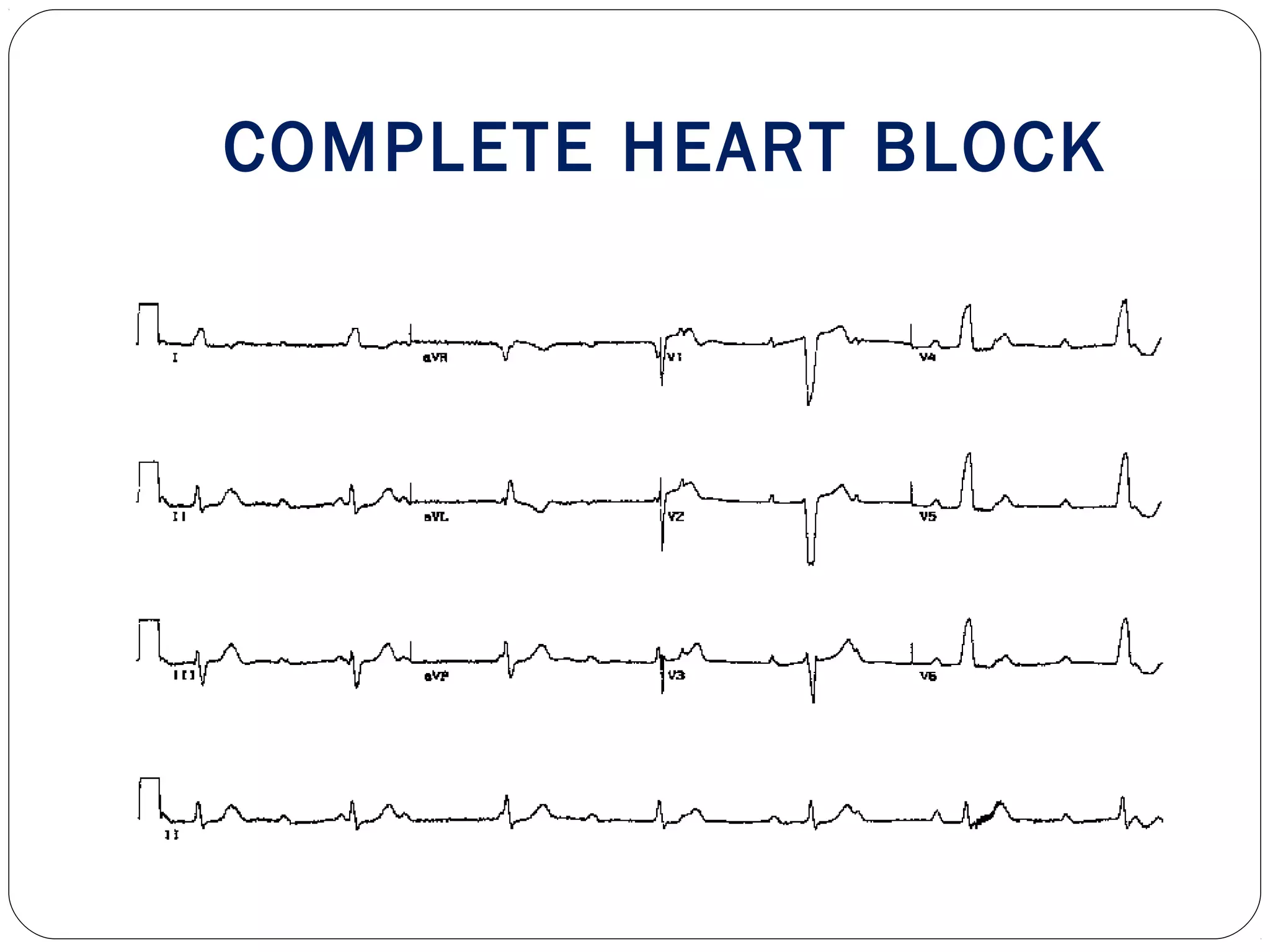 COMPLETE HEART BLOCK
 