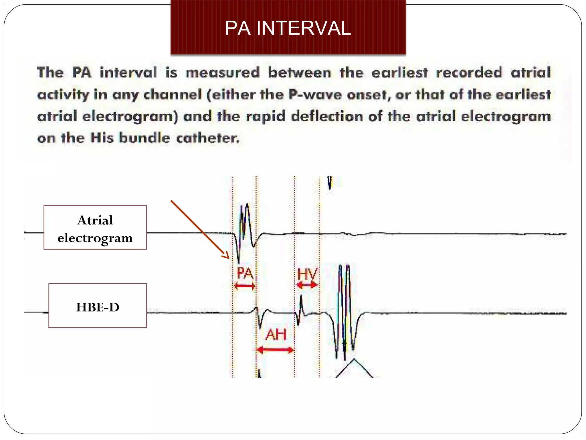 PA INTERVAL
Atrial
electrogram
HBE-D
 