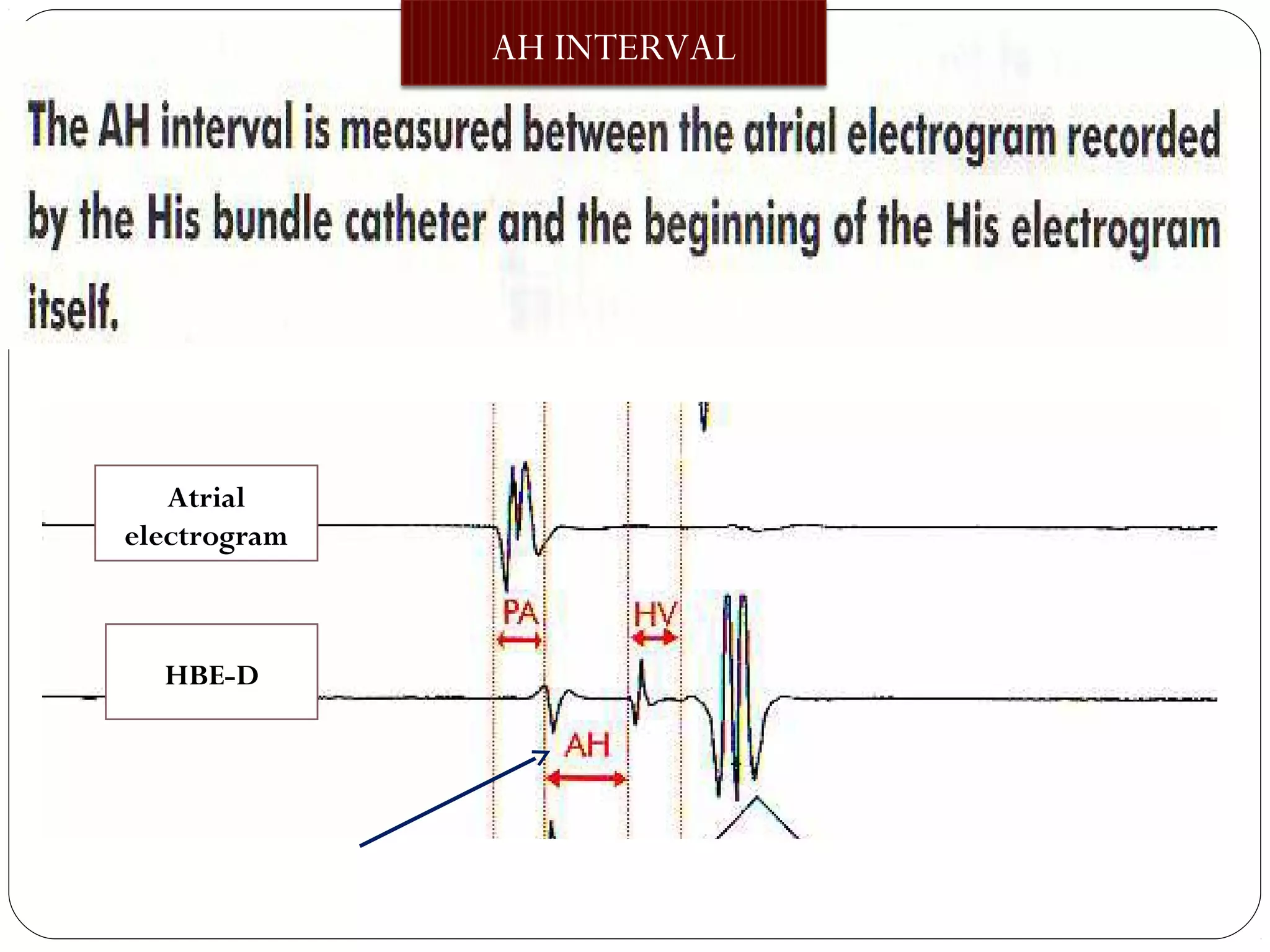 AH INTERVAL
AH INTERVAL
Atrial
electrogram
HBE-D
 