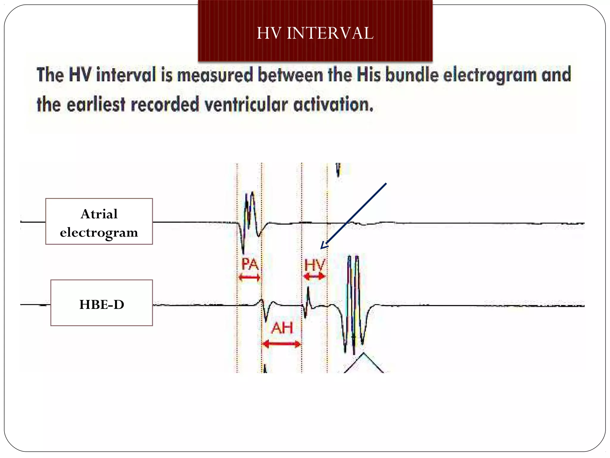 HV INTERVAL
Atrial
electrogram
HBE-D
 