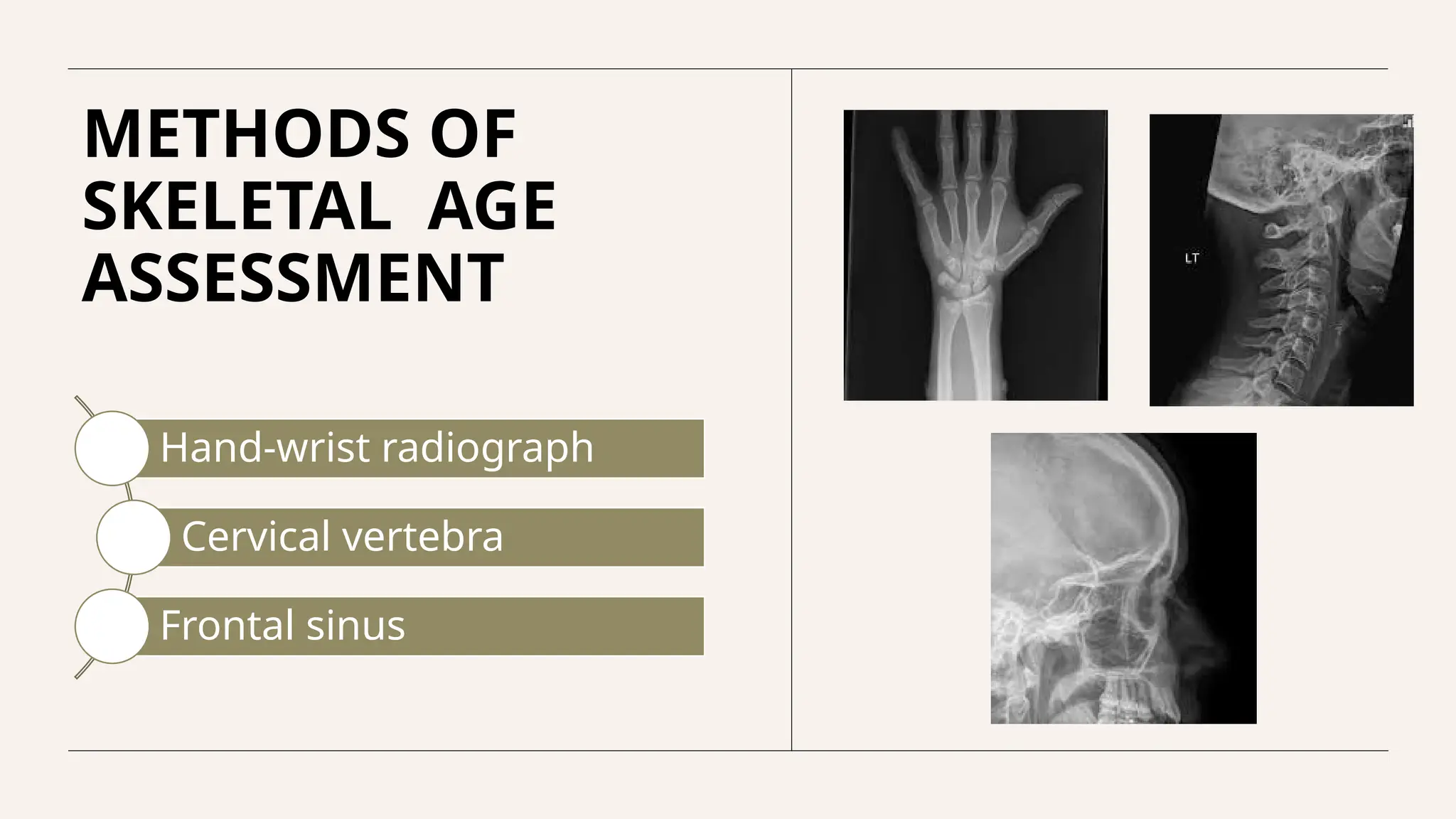 Assessment of skeletal age in Orthodontics | PPTX
