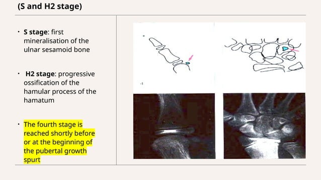 Assessment of skeletal age in Orthodontics | PPTX