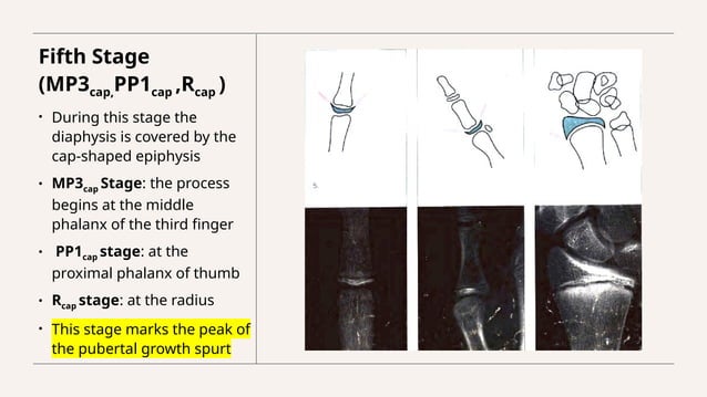 Assessment of skeletal age in Orthodontics | PPTX
