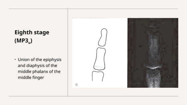 Assessment of skeletal age in Orthodontics | PPTX