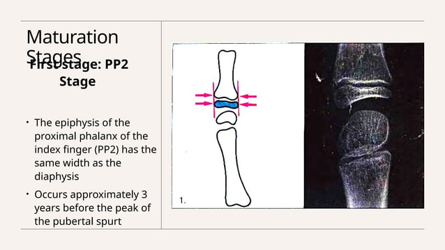 Assessment of skeletal age in Orthodontics | PPTX