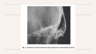 Assessment of skeletal age in Orthodontics (2).pptx