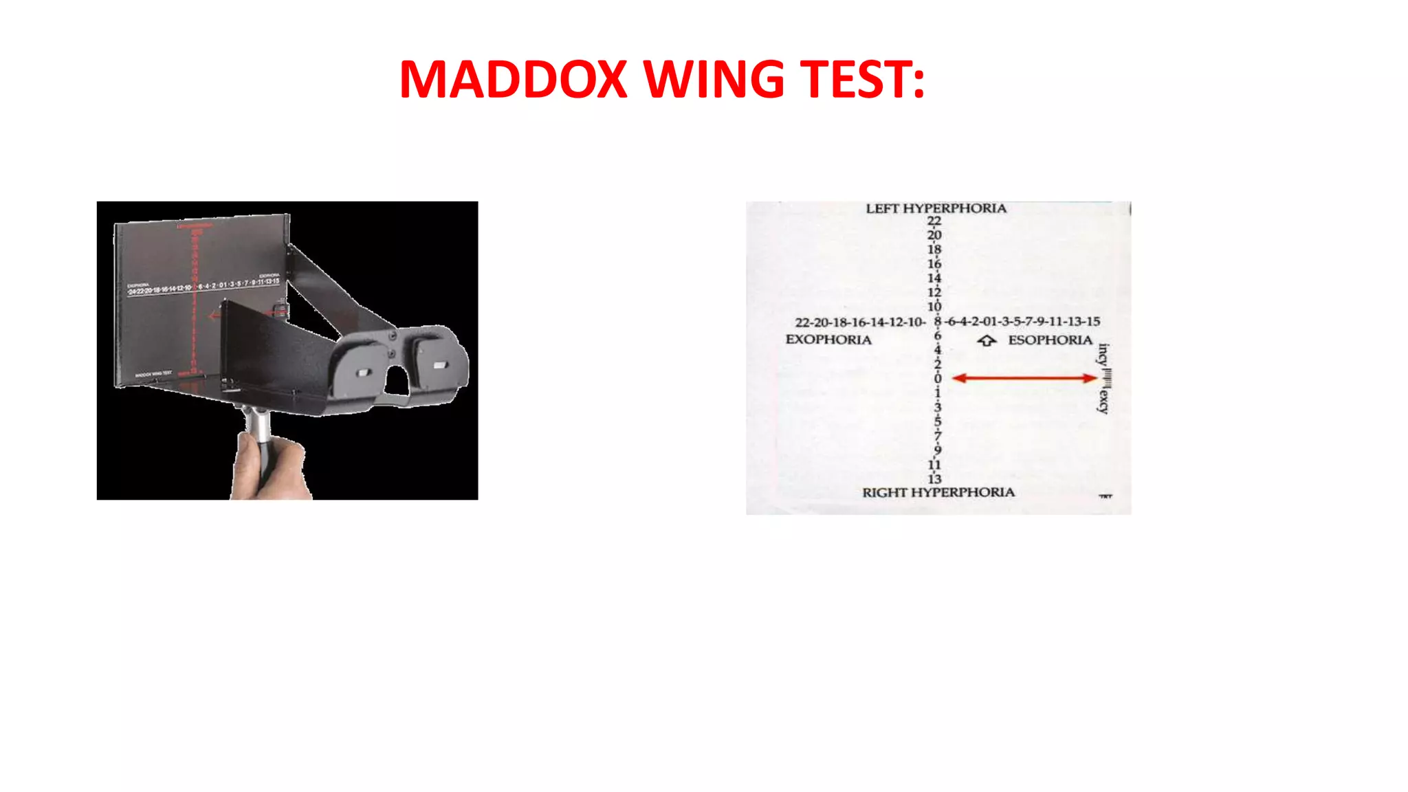 MADDOX WING TEST:
 