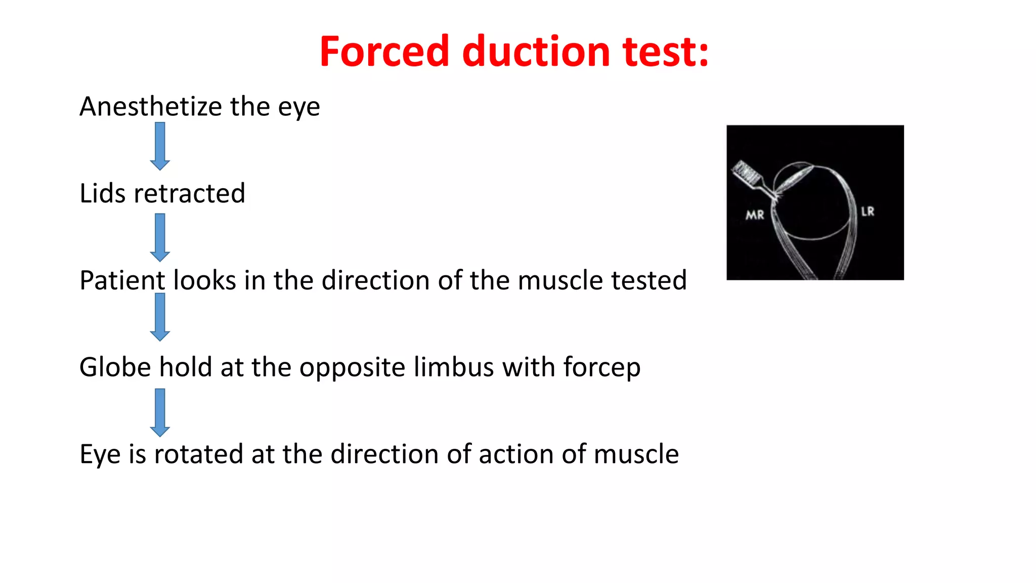 Forced duction test:
Anesthetize the eye
Lids retracted
Patient looks in the direction of the muscle tested
Globe hold at the opposite limbus with forcep
Eye is rotated at the direction of action of muscle
 