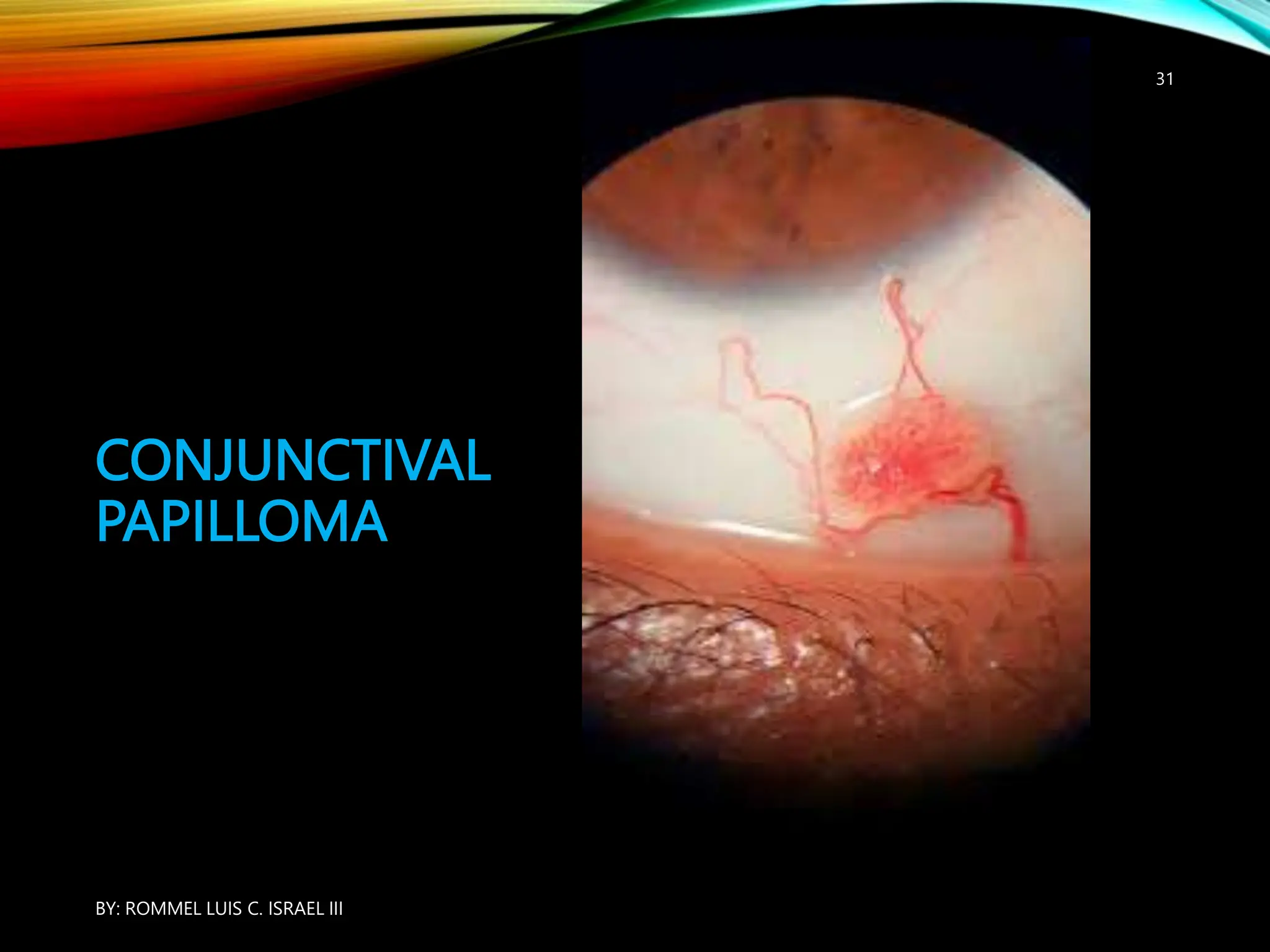 ASSESSMENT OF THE EYE 1 Health Assessment ppt assessment-of-the-eye-1-health-assessment-ppt