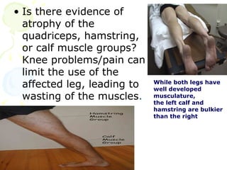 Leg Hamstring Atrophy Assessment of the musclo skletal system | PPT