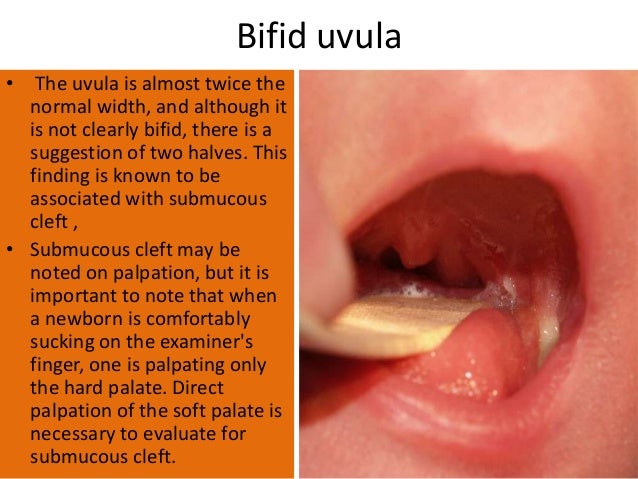 Normal Uvula Variations Assessment of the new born