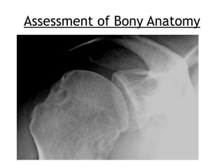 Assessment of the unstable shoulder | PDF