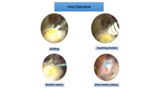 Anchor Incision Pattern Assessment Sport Injury 16.08.22 (Nunung, Bertian, Nadhief, Andini).ppt