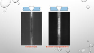 Concave root Excessive root penetration
 